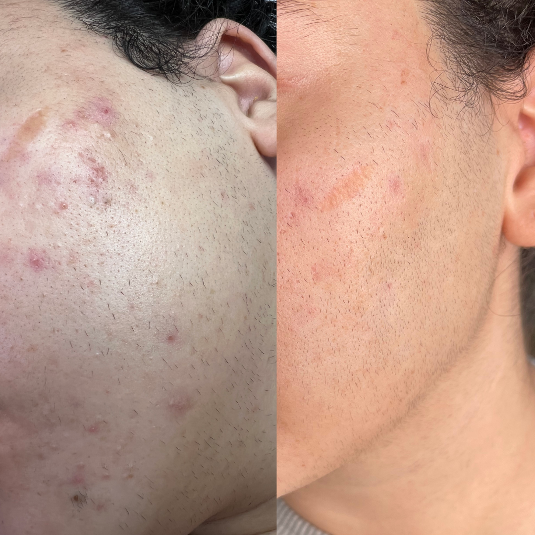 Imperfection Peel Booster