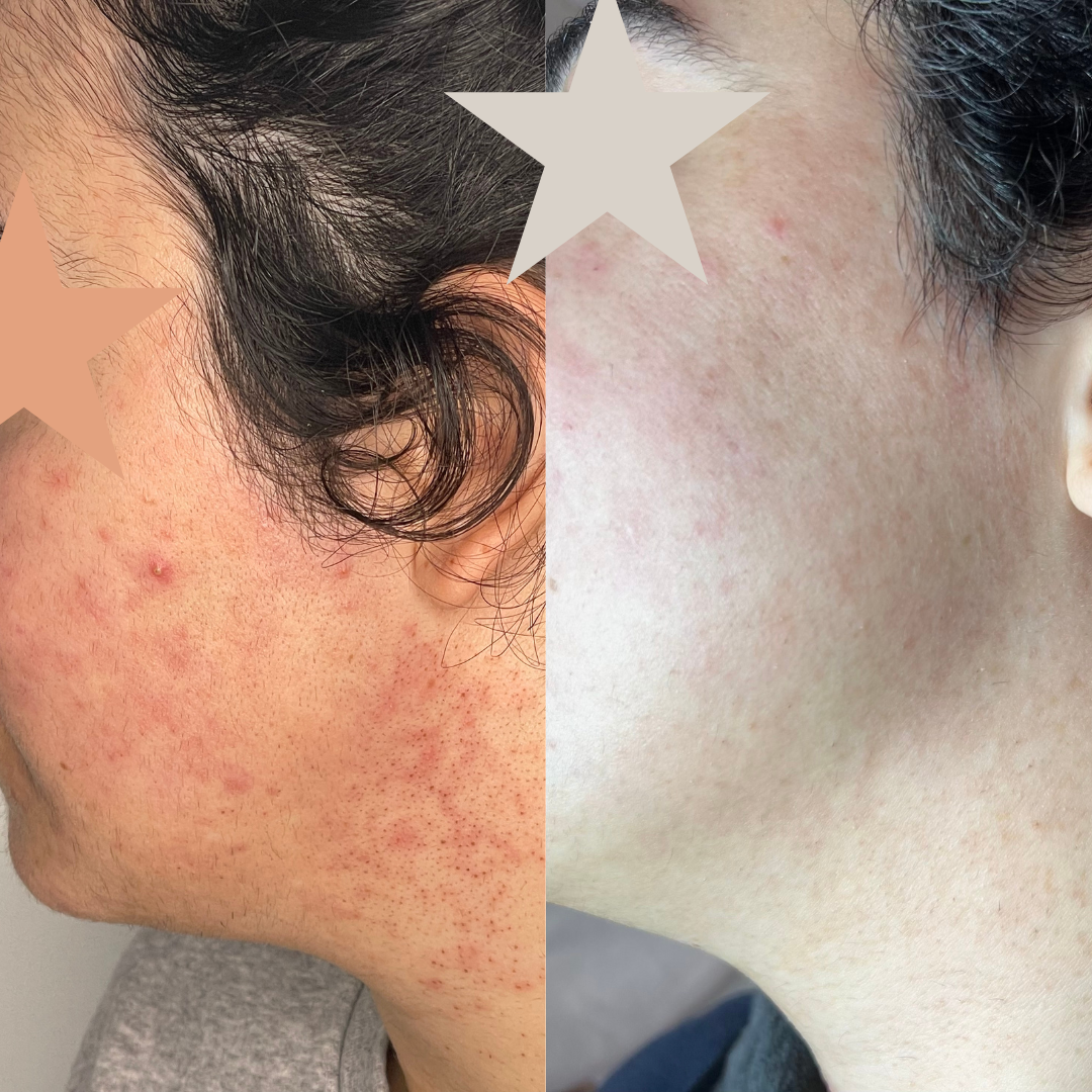 Imperfection Peel Booster